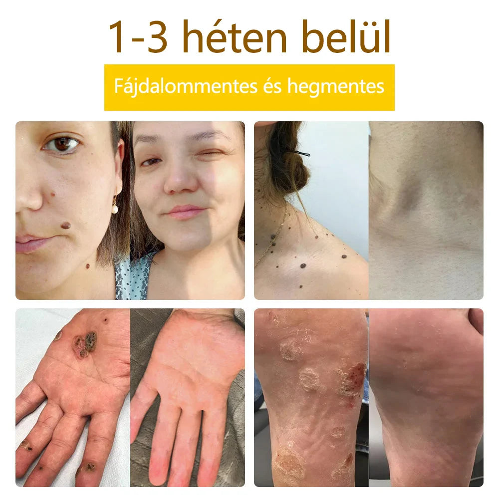 ✅flysmus™ méhméreg kezelő krém🐝: Ekcéma, pikkelysömör, akne, rosacea, gombás fertőzések, szemölcsök kezelése