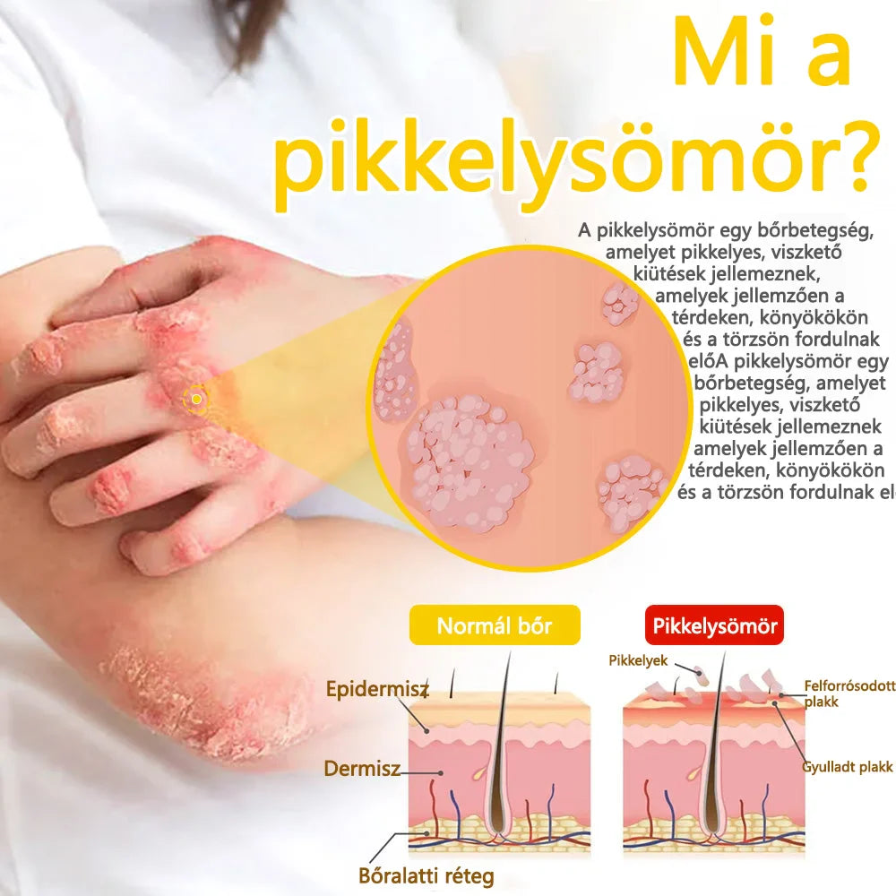 ✅flysmus™ méhméreg kezelő krém🐝: Ekcéma, pikkelysömör, akne, rosacea, gombás fertőzések, szemölcsök kezelése