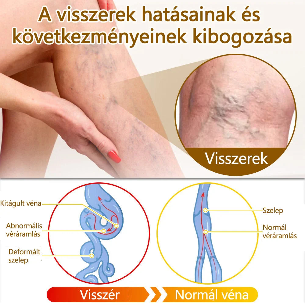 ✅flysmus™ méhméreg kezelő krém🐝: Ekcéma, pikkelysömör, akne, rosacea, gombás fertőzések, szemölcsök kezelése