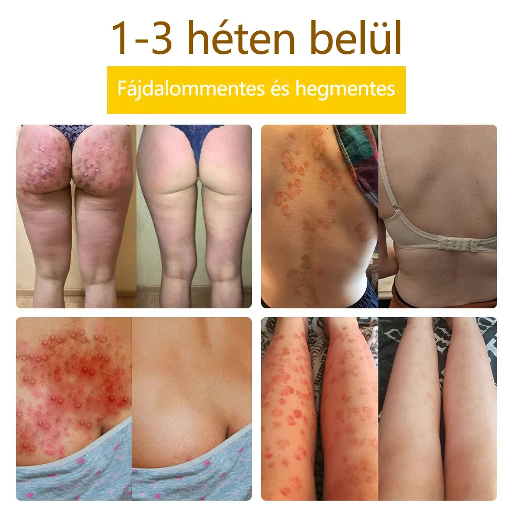 ✅flysmus™ méhméreg kezelő krém🐝: Ekcéma, pikkelysömör, akne, rosacea, gombás fertőzések, szemölcsök kezelése