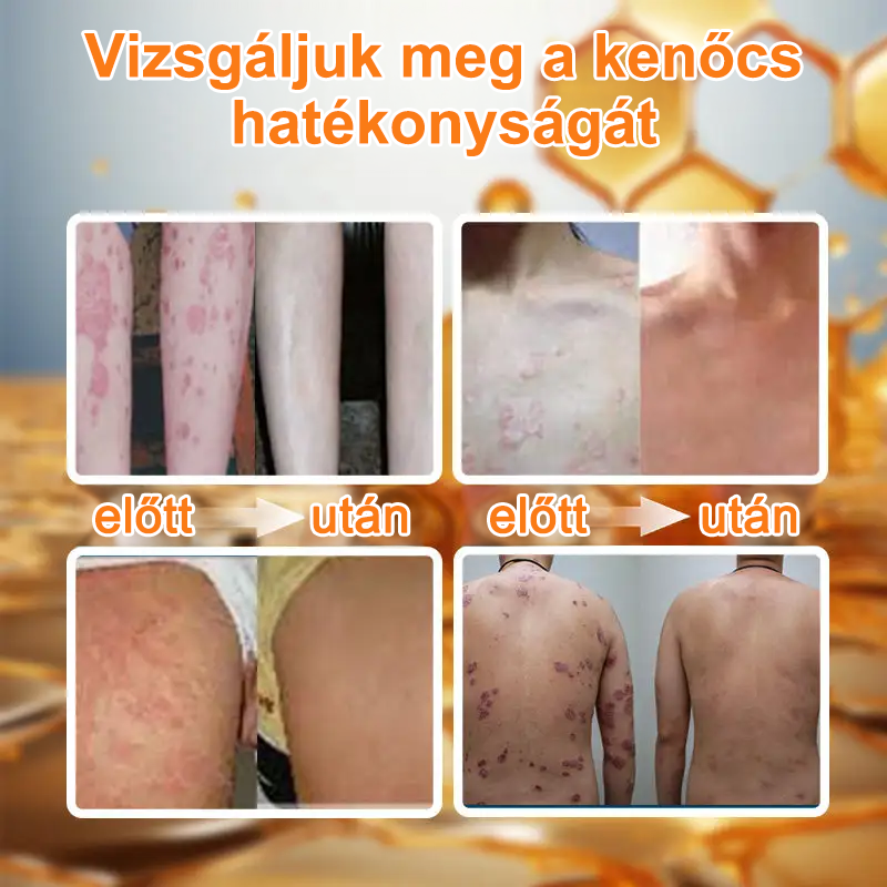 Ourlyard™ Méhméreg Haladó Psoriasis Kezelő Kenőcs (👨Orvos által ajánlott)