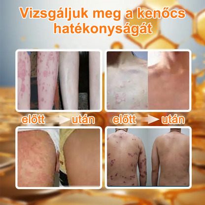 Ourlyard™ Méhméreg Haladó Psoriasis Kezelő Kenőcs (👨Orvos által ajánlott)